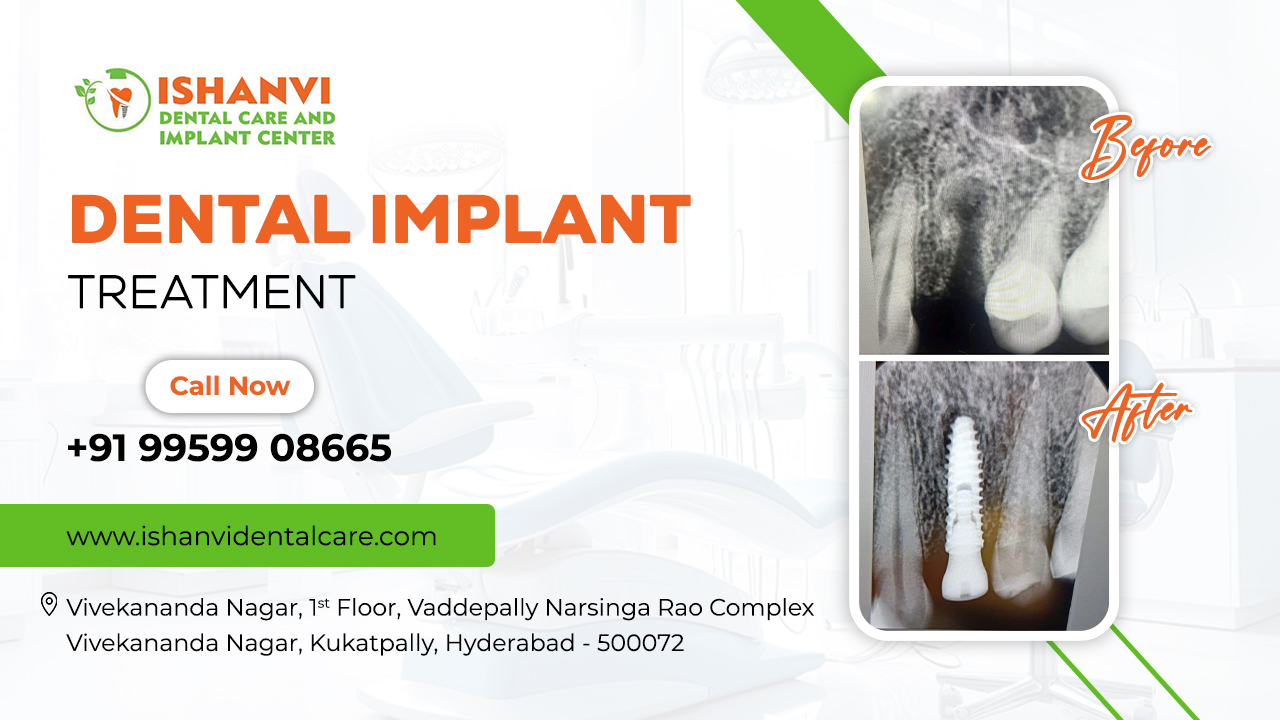 Best Dental Implants Vivekananda Nagar