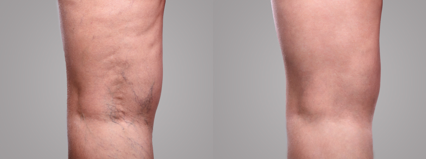 Top Rated Vein Centers In New Jersey