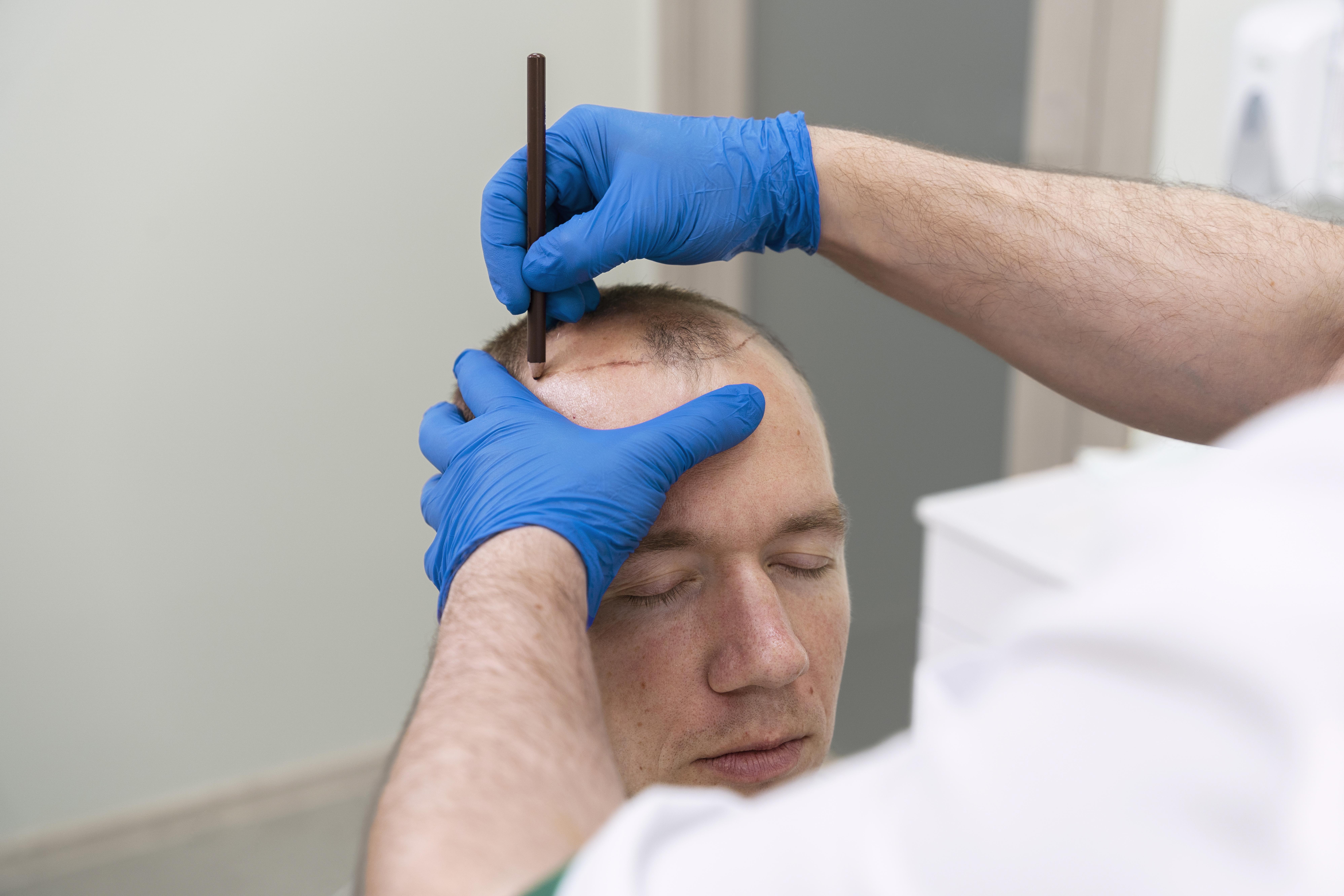 Best Hair Transplant Surgery in Delhi