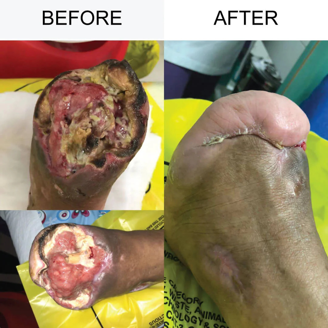 Anwar Pasha Laboratories Herbal Cure Centre For Gangrene | Diabetic Foot Ulcer Treatment | Varicose Veins Specialist Hyd