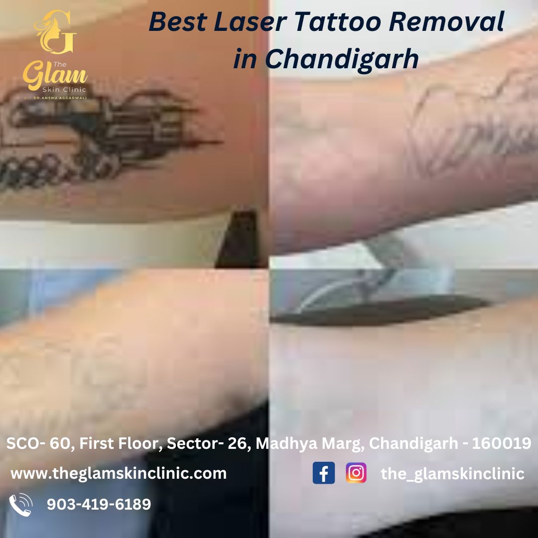 Best Laser Tattoo Removal in Chandigarh