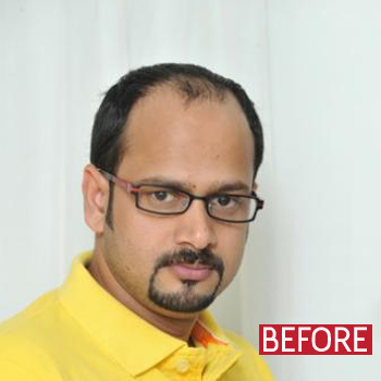 Hair Fixing in Trichy