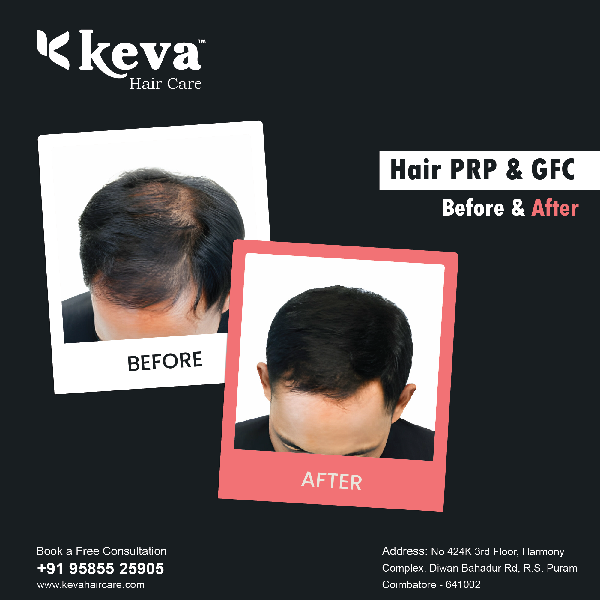 Discover the Best Hair Transplant in Coimbatore: Keva Hair Care