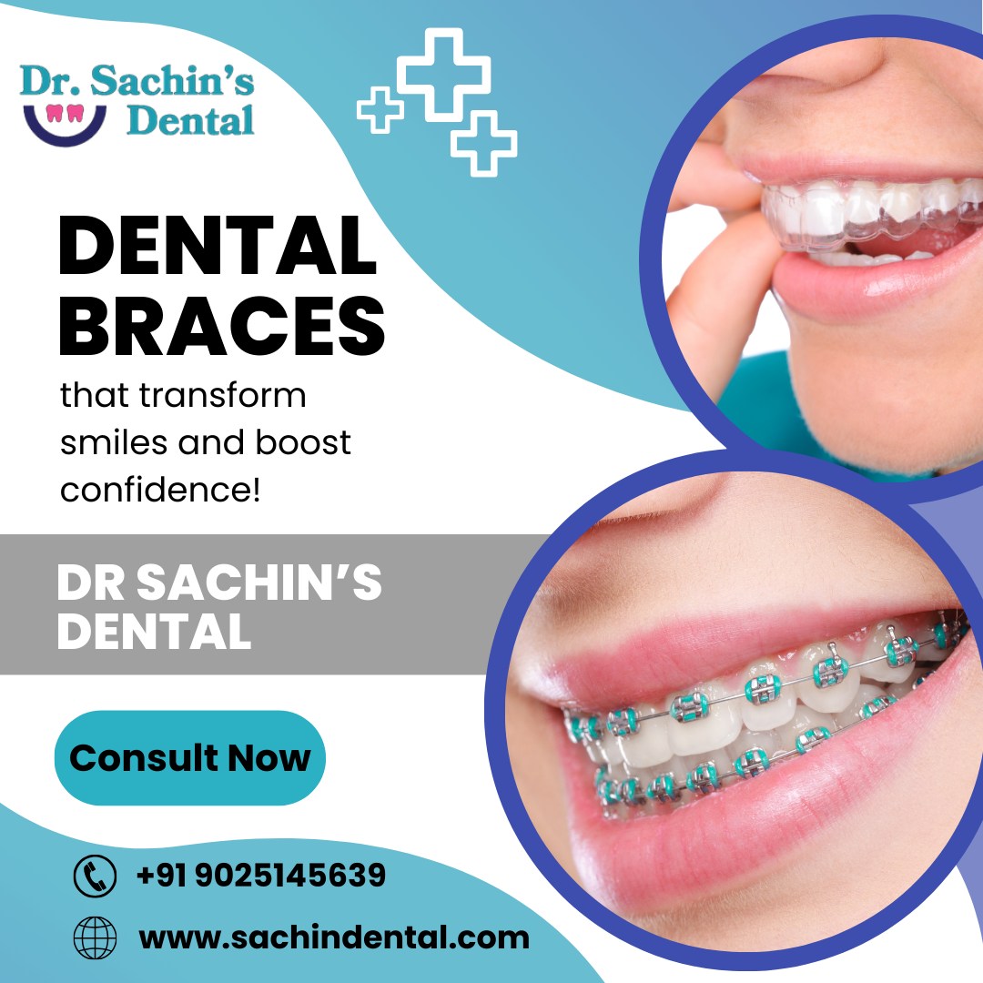 Dental Braces in Patna - Dr. Sachin’s Dental (Contact - 9025145639)