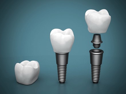 Dental Implants Cost Sydney at $2850