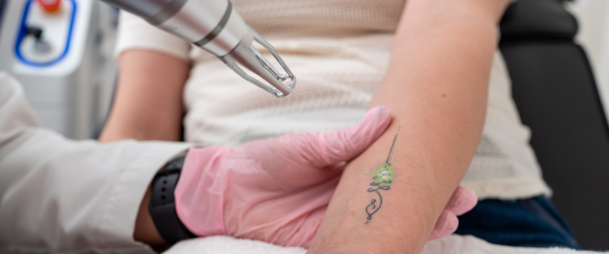 Benefits of Laser Tattoo Removal Over Traditional Methods: A Dermatologist’s Expert Perspective