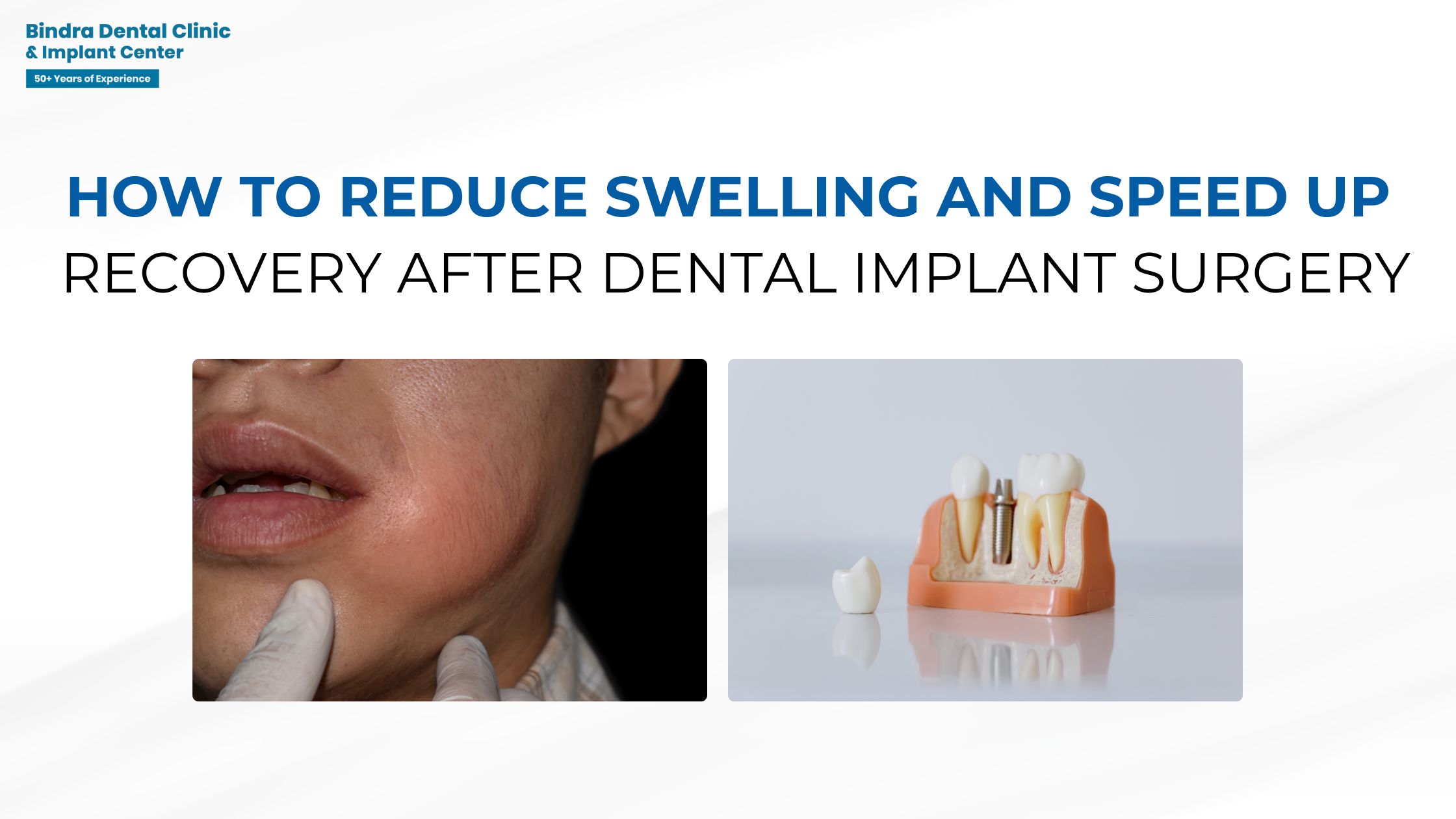 how to reduce swelling and speed up recovery after dental implant surgery