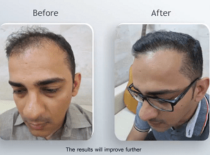 Hair Transplantation | Re-Grow Hair Loss | New Delhi | Satya
