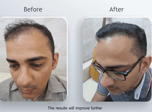 Hair Transplantation | Re-Grow Hair Loss | New Delhi | Satya Hair Transplantation | Re-Grow Hair Loss | New Delhi | Satya