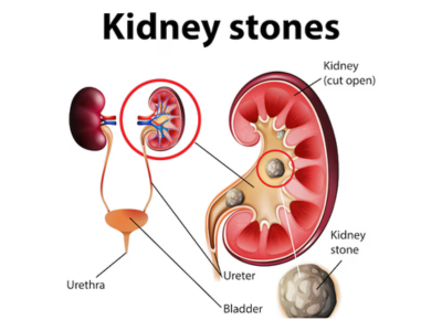 DR. DEVAL PARIKH | UROLOGIST - URO SURGEON - URO ONCOLOGIST -  KIDNEY SPECIALIST