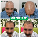 REDEFINE PLASTIC SURGERY & HAIR TRANSPLANT IN HYDERABAD