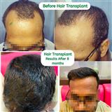 REDEFINE PLASTIC SURGERY & HAIR TRANSPLANT IN HYDERABAD