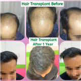 REDEFINE PLASTIC SURGERY & HAIR TRANSPLANT IN HYDERABAD