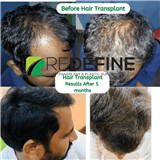 REDEFINE PLASTIC SURGERY & HAIR TRANSPLANT IN HYDERABAD
