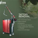 AHMEDABAD TATTOO REMOVAL