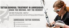 AHMEDABAD TATTOO REMOVAL